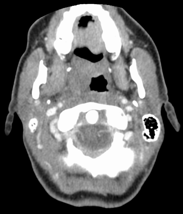 Axial CT scan showing right sided peri-tonsillar abscess with bulging in the oropharyngeal region 