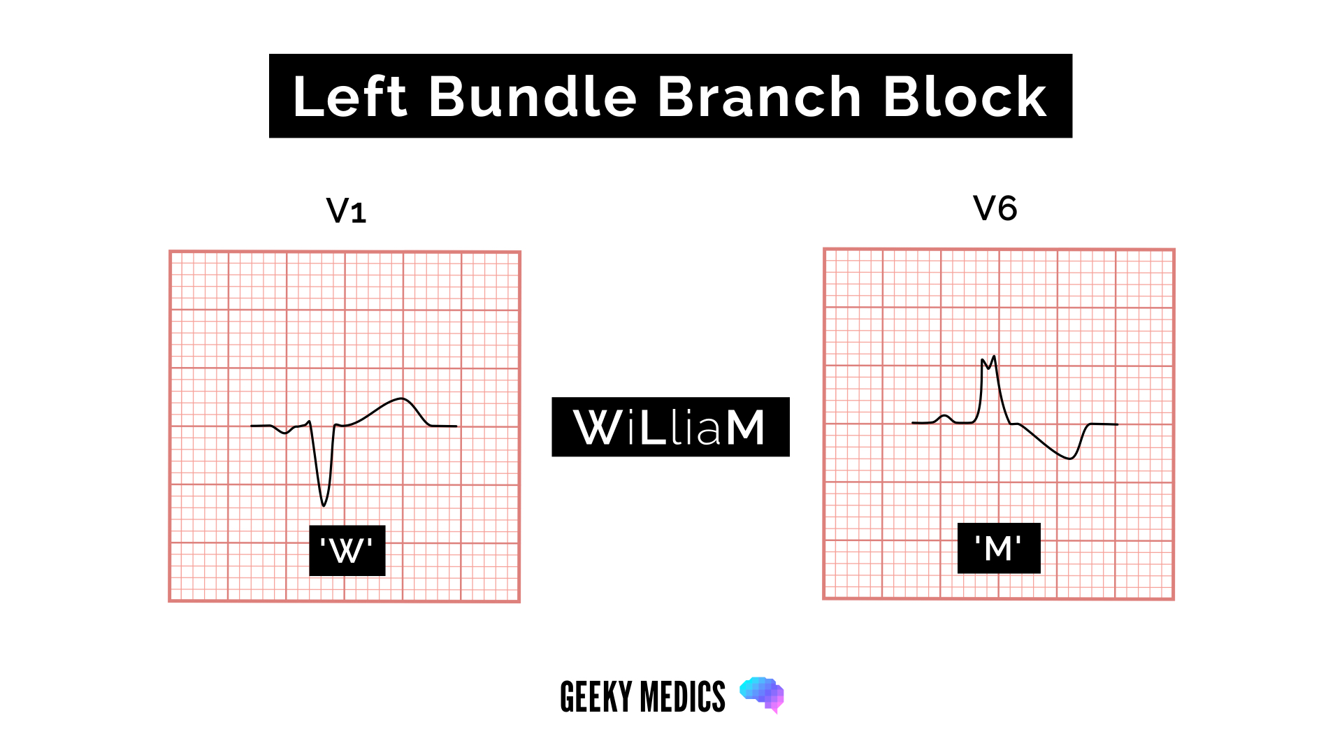 ECG features of left bundle branch block