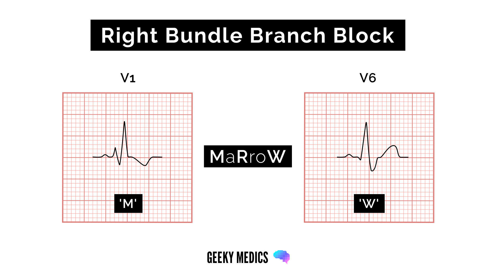 ECG features of right bundle branch block