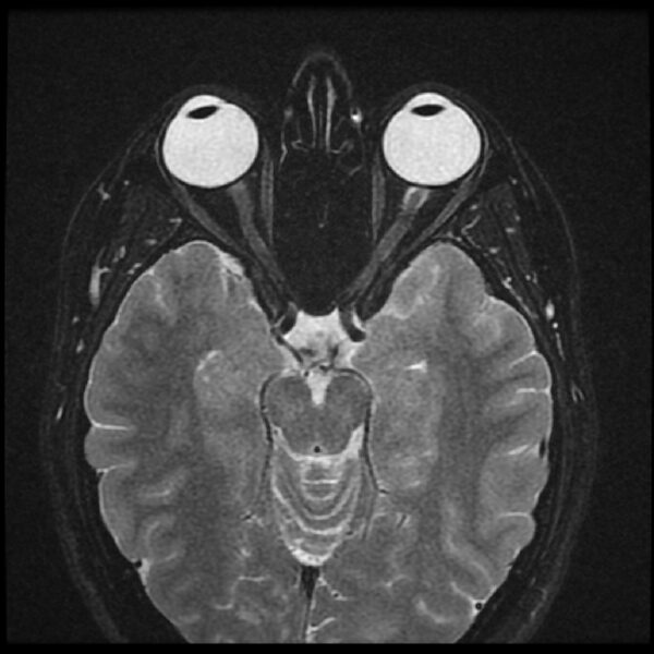 Optic Neuritis MRI