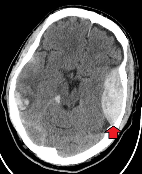  Extradural haematoma demonstrated on CT