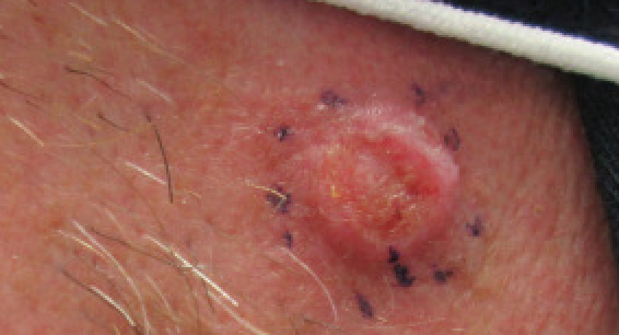 Squamous cell carcinoma on the cheek