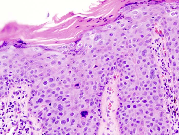 Cutaneous Squamous Cell Carcinoma (SCC) | Skin Cancer | Geeky Medics