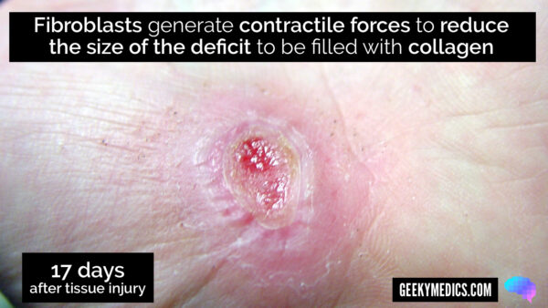 Wound contraction