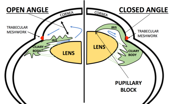 Comparison of open and closed angles in the eye.