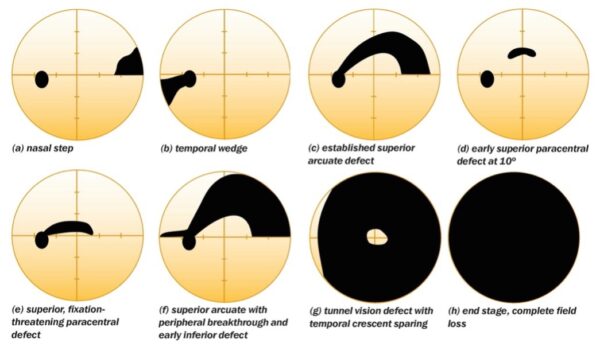 Visual field defects seen in glaucoma