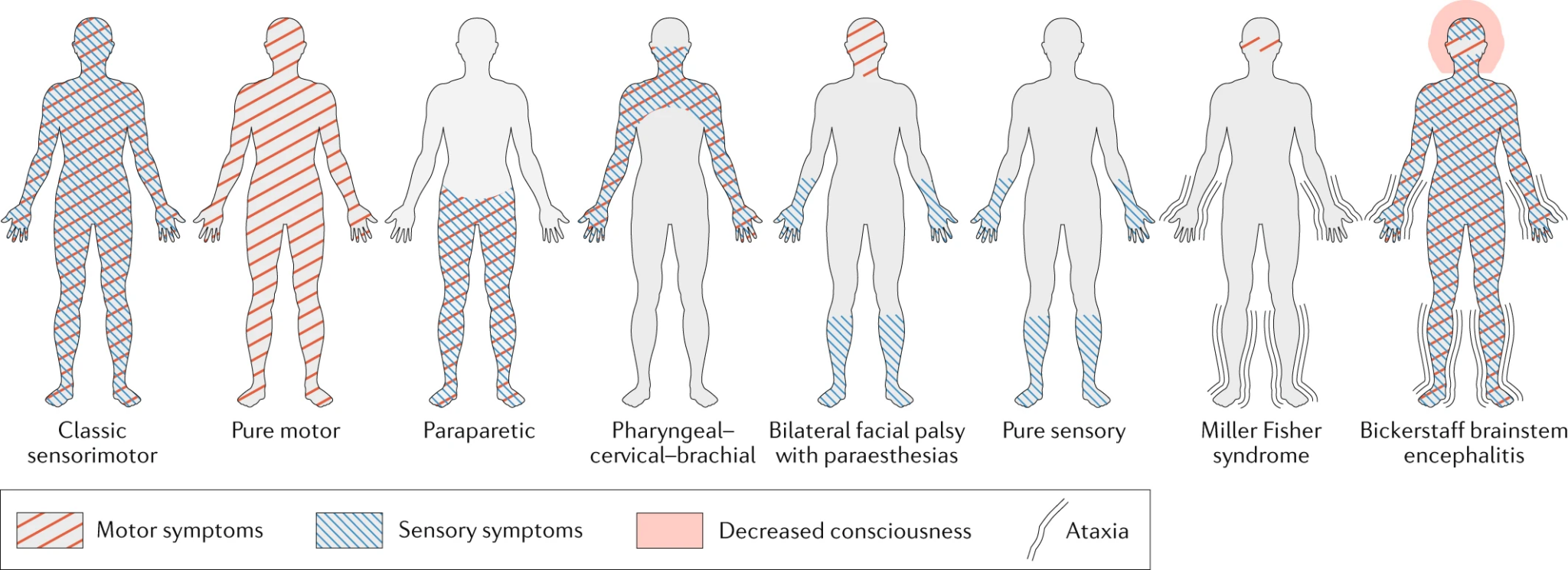 Patterns of symptom distribution of different variants of Guillain-Barre Syndrome