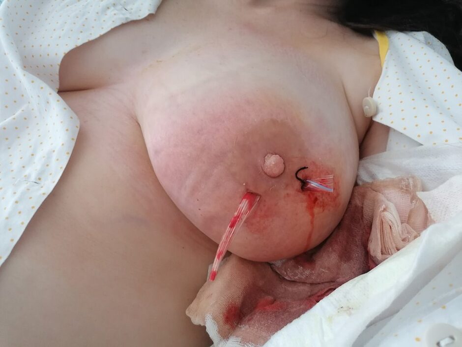 Breast abscess after surgical intervention