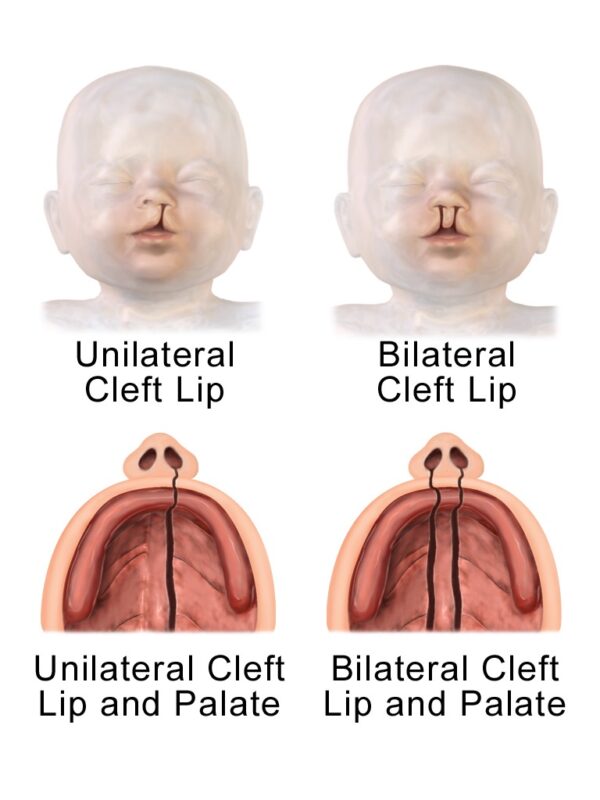 Diagram showing how unilateral and bilateral cleft lip and palate may look.