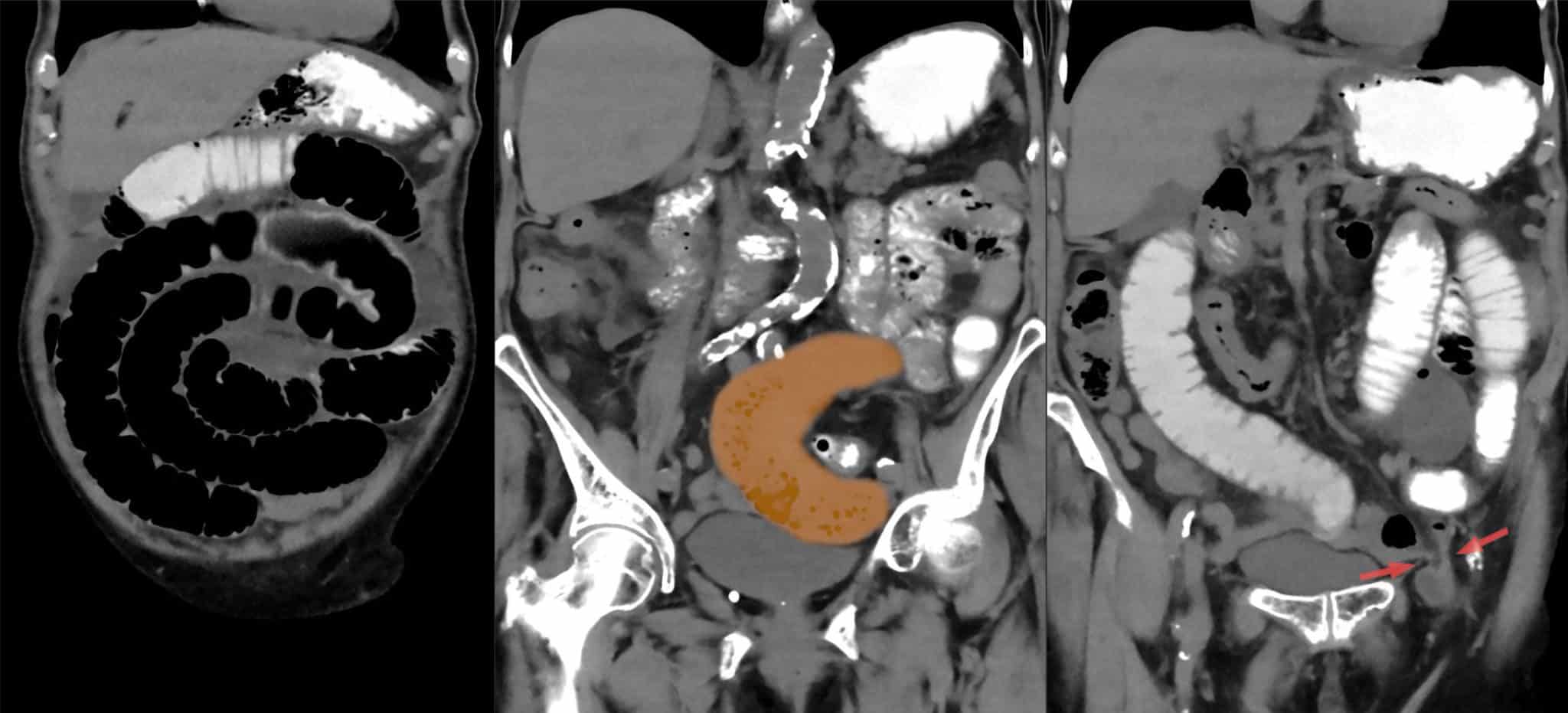 CT scan showing an obstructed femoral hernia