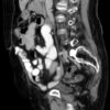 CT scan of a Richter's hernia (sagittal)