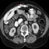 CT scan of a Richter's hernia