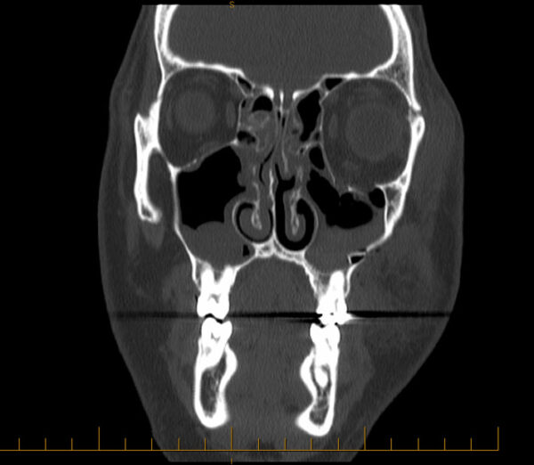 Coronal CT scan demonstrating a left blowout fracture