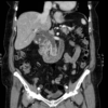 Figure 18. Coronal CT scan showing biliary dilatation with two large stones in the distal CBD (arrow)