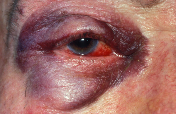 Eyelid haematoma and subconjunctival haemorrhage following blunt force injury to the eye