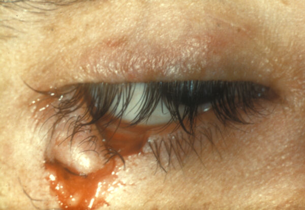 A full-thickness, margin-involving, lower eyelid laceration of the right eye