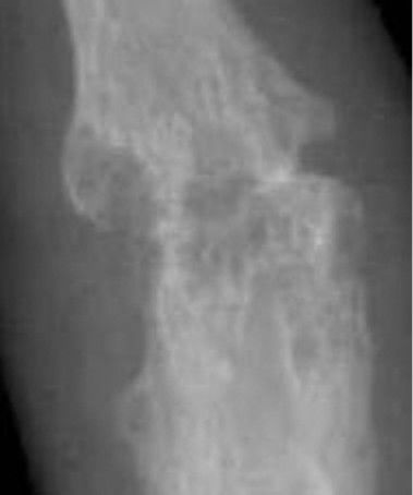 X-ray of right fourth proximal interphalangeal (PIP) joint with bone erosions by rheumatoid arthritis