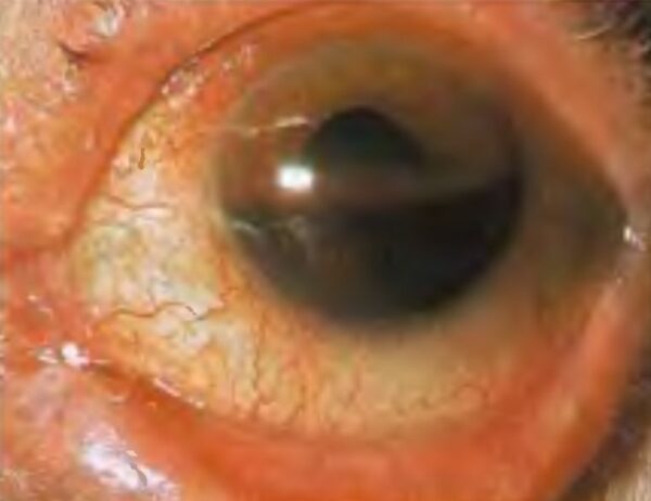 Hyphaema occupying half of the anterior chamber of the eye