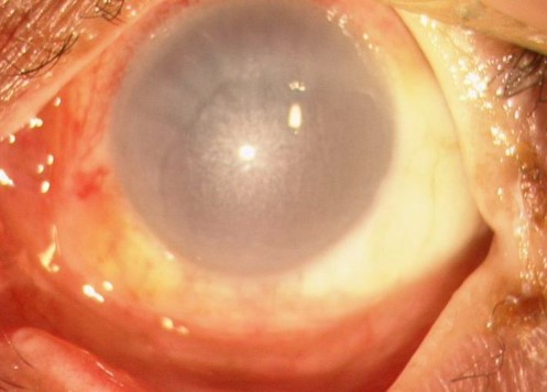 A chemical injury demonstrating corneal haze and perilimbal blanching (ischaemia). The presence of either of these features should prompt urgent specialist evaluation
