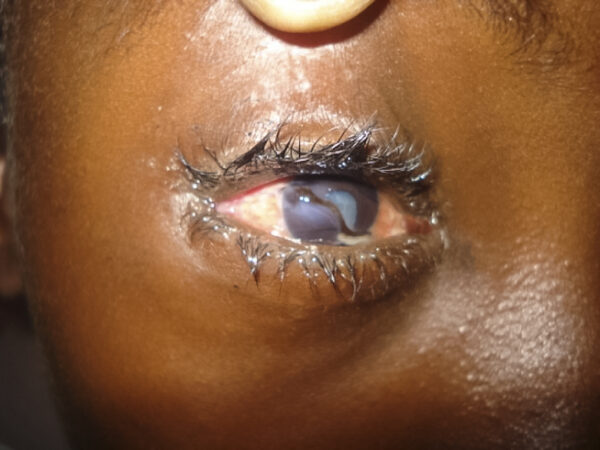 A full-thickness corneal laceration with iris plugging of the wound, misshapen pupil and traumatic cataract