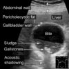Figure 10. Labelled ultrasound image showing small gallstones and gallbladder sludge. All types of gallstones are highly echogenic, which means they reflect lots of ultrasound waves. This gives them a bright white appearance with characteristic "acoustic shadowing".