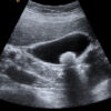 Figure 11. A different ultrasound view showing a large solitary gallstone. Again, the stone appears bright white and you can see the acoustic shadowing behind it.