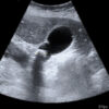 Figure 12. Ultrasound showing a gallstone impacted in the gallbladder neck