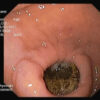 Figure 31. An OGD performed on a patient with Bouveret's syndrome. There was a large gallstone in the duodenal bulb which was completely stuck and could not be removed.