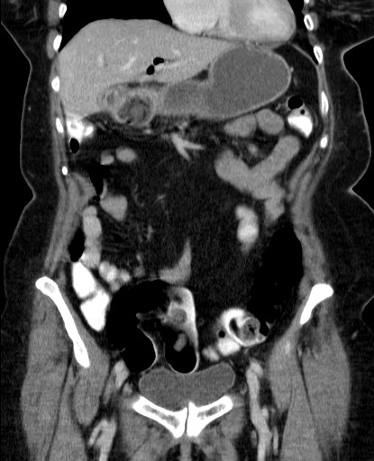 Figure 30. Coronal CT scan showing Rigler's triad in a patient with Bouveret's syndrome. There is a fluid-filled stomach with pneumobilia and a large gallstone impacted in the proximal duodenum.