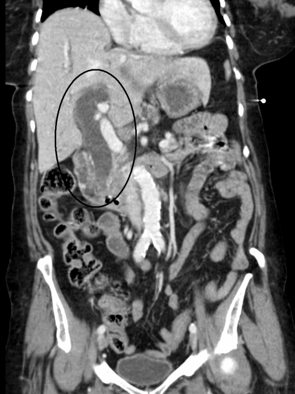 Figure 38. Coronal CT scan showing biliary dilatation due to distal CBD obstruction of unknown cause. This patient requires urgent investigations to assess for an underlying malignancy.