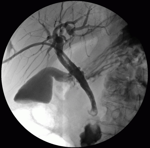 Figure 22. An X-ray cholangiogram taken during PTC and biliary drainage. The drain comes in horizontally at the 10 o'clock position then passes along the right hepatic duct into common bile duct. If you look closely you can also see multiple stones stacked up in the CBD.