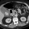 Figure 14. Axial CT scan showing acute cholecystitis with gallbladder wall thickening, pericholecystic inflammatory fat stranding and a large gallstone