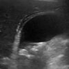 Figure 13. Ultrasound of acute cholecystitis showing gallstones, gallbladder wall thickening and pericholecystic fluid (the dark stripe around the gallbladder on the top left)
