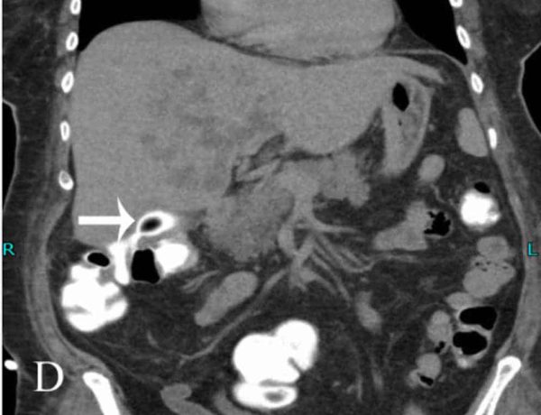 Figure 39. Coronal CT scan with rectal contrast showing a cholecystocolonic fistula tract (arrow). This patient also has multiple liver abscesses.