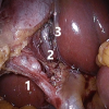 Figure 4. The critical view of safety during a laparoscopic cholecystectomy. The surgeon has mobilised the gallbladder neck from the liver bed (3) and clearly identified the cystic artery (1) and cystic duct (2). You can also see the cystic lymph node sitting on top of the artery.