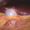 Figure 2. A normal gallbladder seen during a laparoscopy