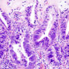Figure 36. Histopathology slide with a H&E stain showing an early gallbladder cancer which was found incidentally in a cholecystectomy specimen. The cancer cells have large, irregularly shaped nuclei and darker-looking cytoplasm.