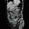 Figure 28. Coronal CT showing Rigler's triad in a patient with gallstone ileus. There is small bowel obstruction with pneumobilia (you can see black pockets of air in the intrahepatic ducts) and an ectopic gallstone in the bowel lumen (arrow).