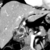 Figure 26. Axial CT scan showing Mirizzi syndrome. There is a large stone in the gallbladder which is obstructing the common hepatic duct (arrows) with dilatation of a proximal intrahepatic duct (triangle).