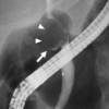 Figure 27. A cholangiogram taken during an ERCP on the same patient. They were found to have a large fistula between the gallbladder and the bile duct, which had allowed part of the stone to pass through and directly obstruct the lumen.