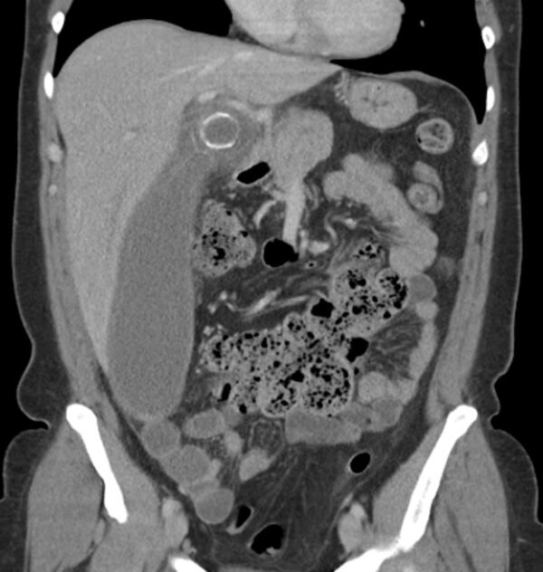 Figure 33. Coronal CT scan showing a large gallbladder mucocoele. The fundus of the gallbladder is in the right iliac fossa.