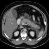 Figure 24. Axial CT scan showing acute interstital oedematous pancreatitis. The pancreas itself looks swollen and there is some inflammatory fat stranding (the fluffy-looking grey discolouration) in the surrounding tissues.