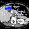 Figure 23. Labelled axial CT scan showing the appearance of a normal pancreas