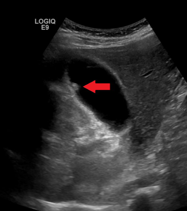 Figure 40. Ultrasound scan showing a small gallbladder polyp. Note that it adheres to the gallbladder wall against gravity and does not cause any acoustic shadowing.