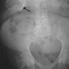 Figure 34. Abdominal X-ray showing a porcelain gallbladder