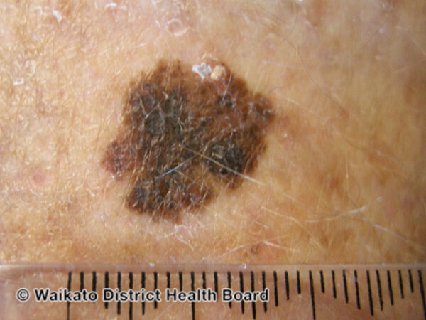 Figure 1. Superficial spreading melanoma