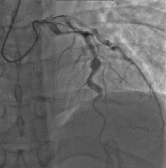 Echocardiogram showing a left anterior descending artery aneurysm in a patient with Kawasaki disease