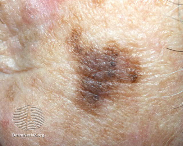 Figure 3: Lentigo melanoma