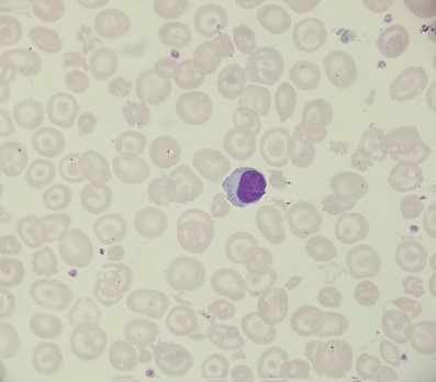 Haemoglobin H disease