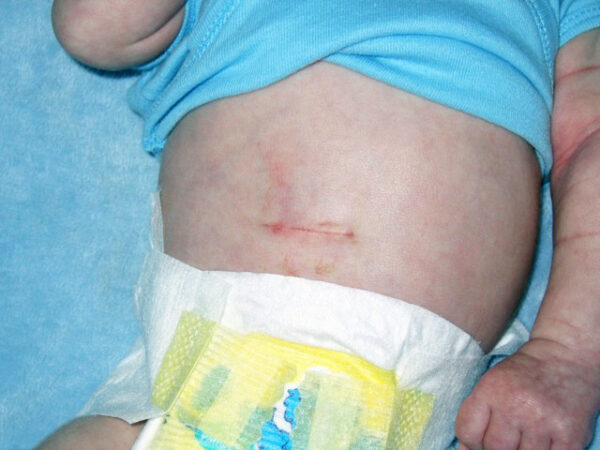 Pyloric stenosis surgical scar